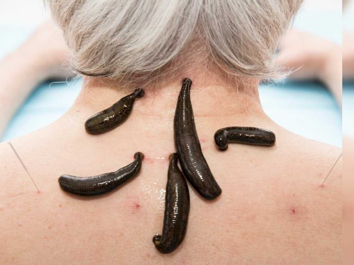 Leech Therapy